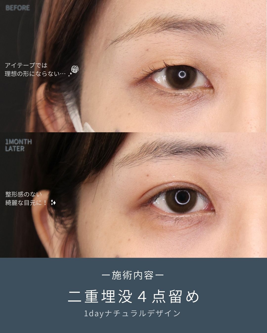 二重埋没法の症例写真 施術前後 