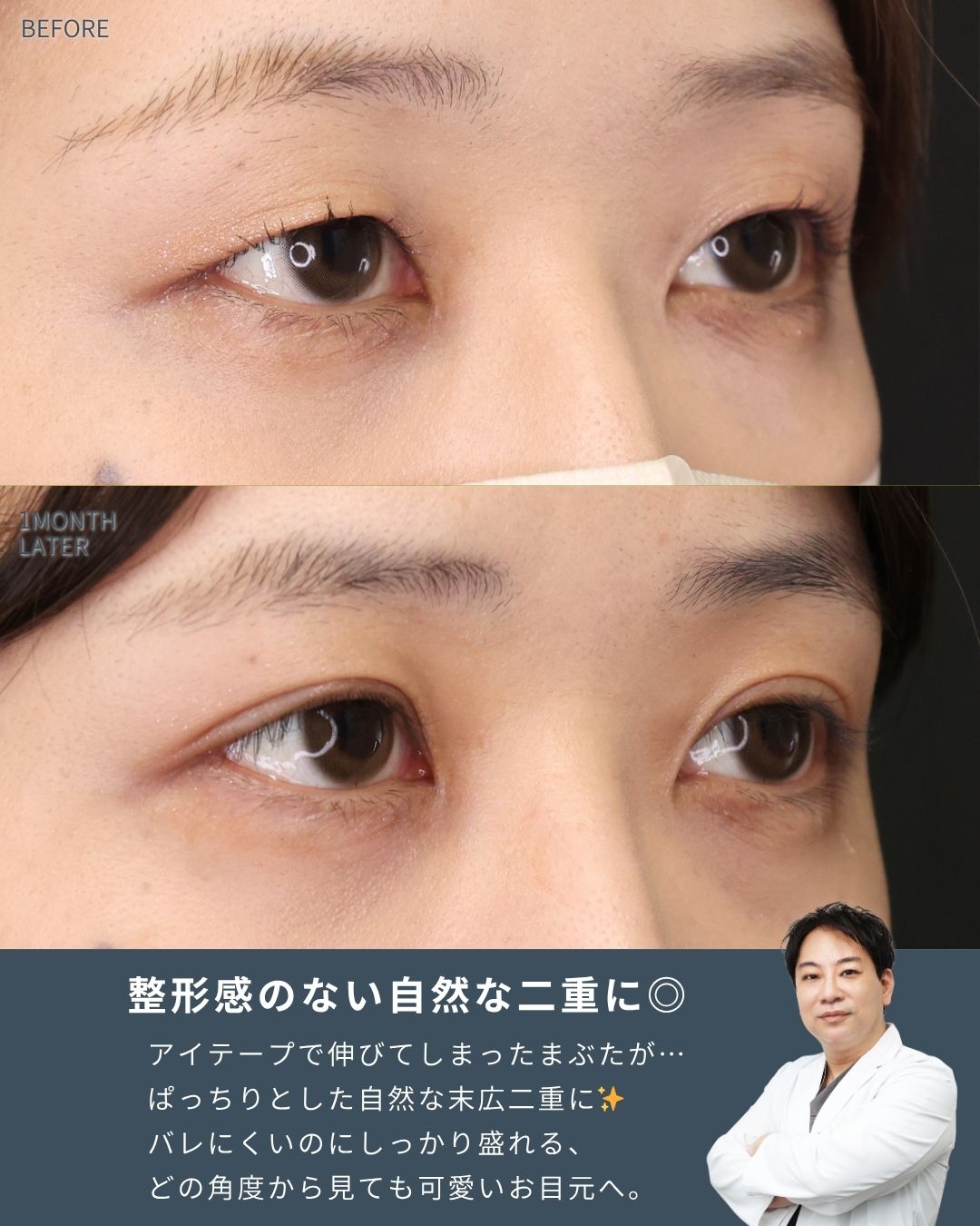 二重埋没法の症例写真 施術前後 