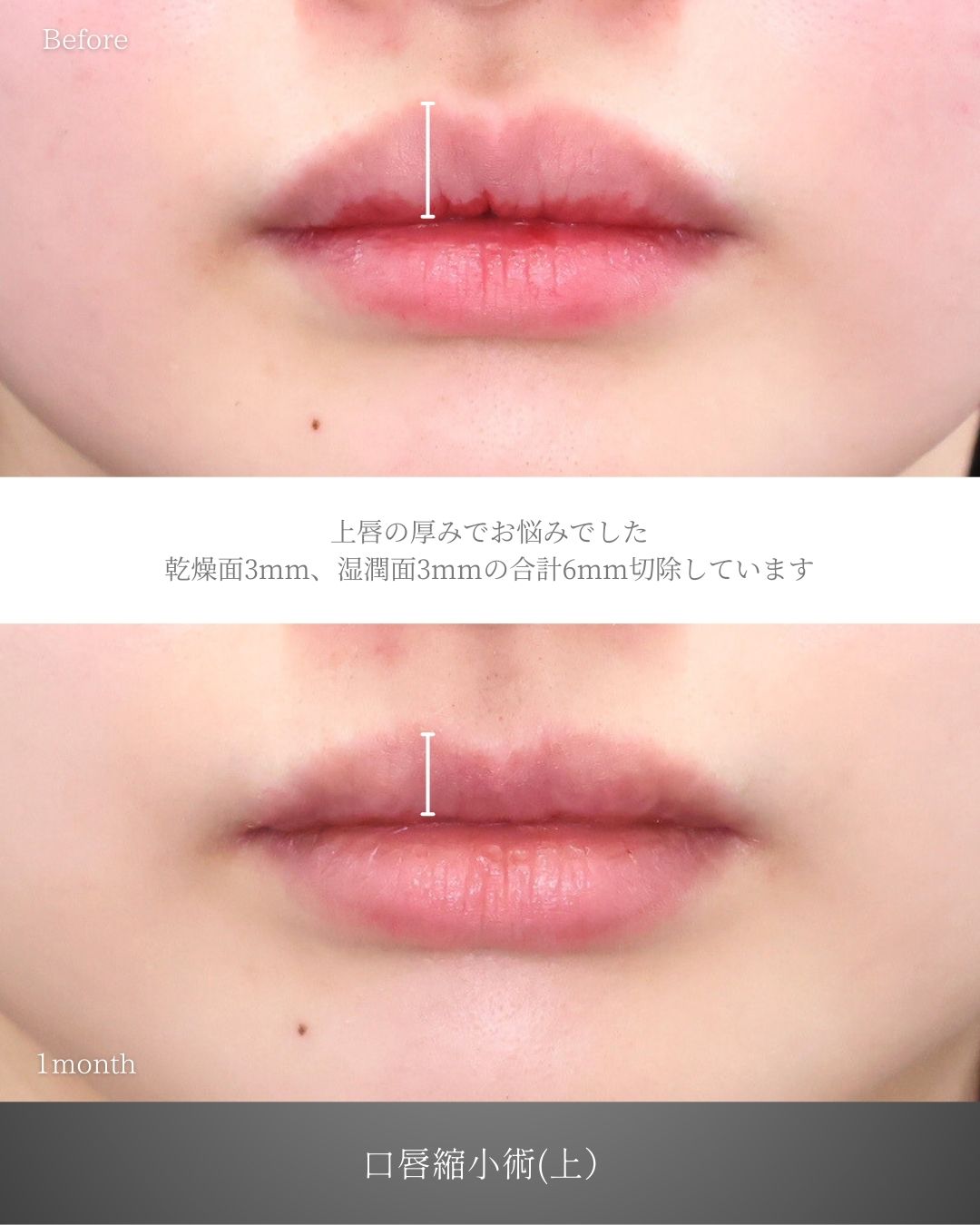 口唇縮小術の症例写真 施術前後 