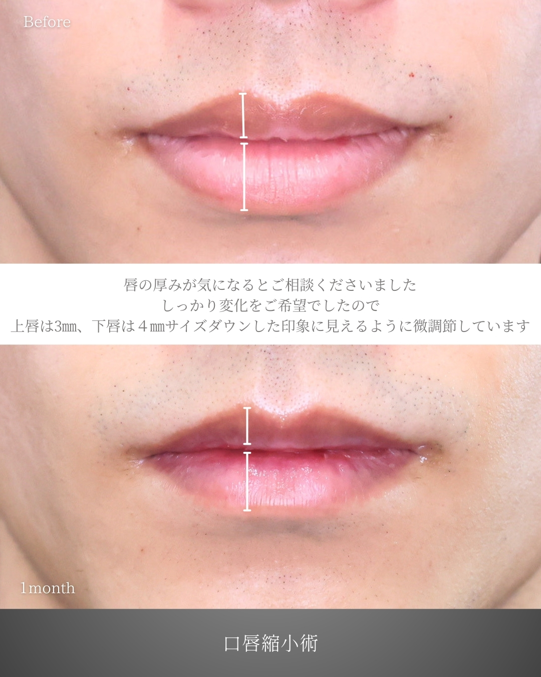 口唇縮小術の症例写真 施術前後 