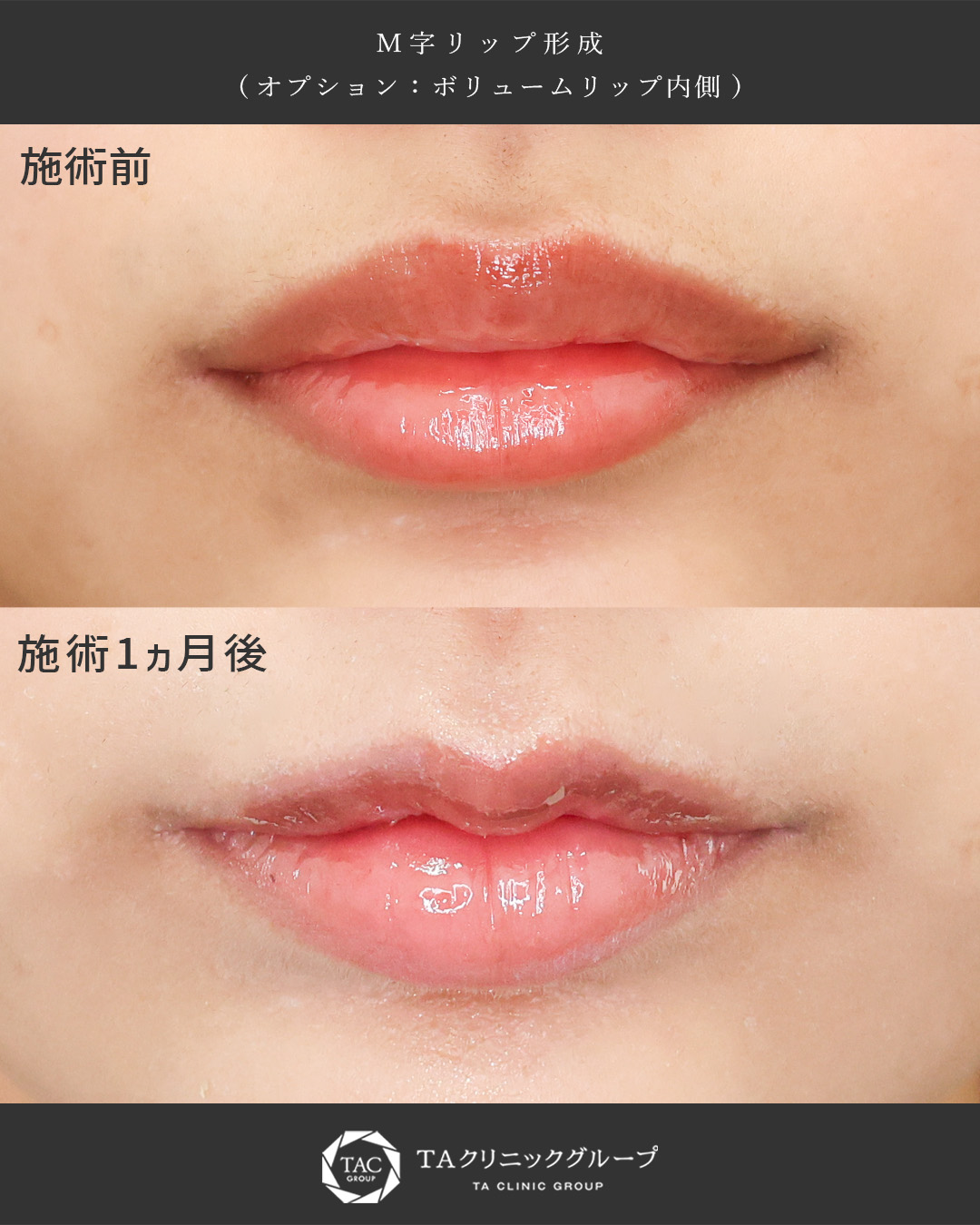 M字リップ形成で可愛らしい上口唇に