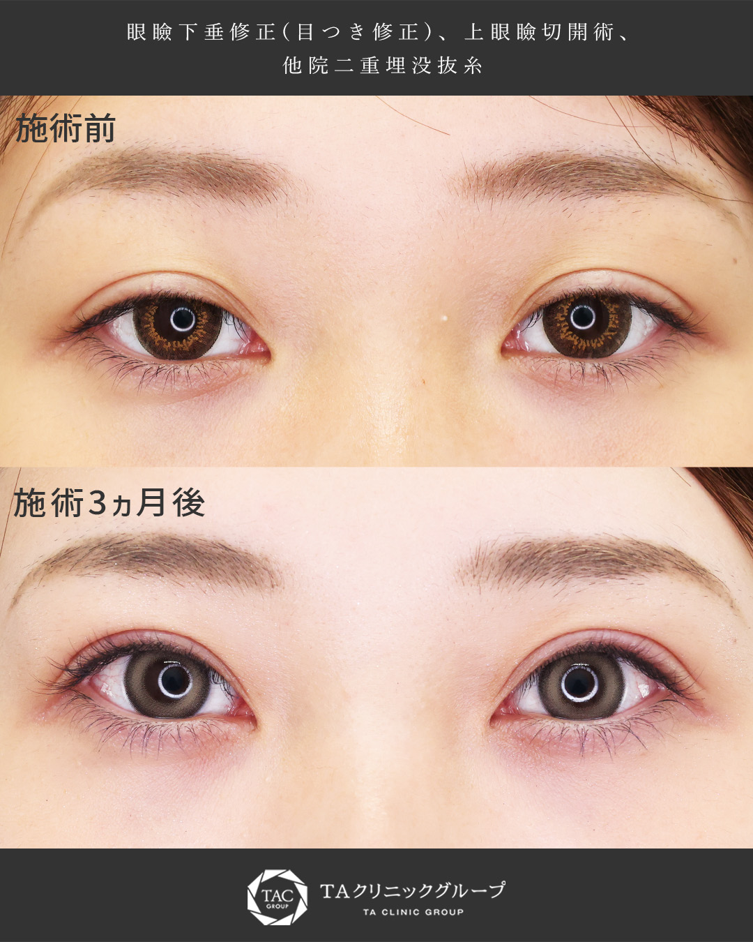他院での埋没を抜去し、眼瞼下垂＋上眼瞼切開術でパッチリ目元に｜形成外科専門医Dr.香山 執刀