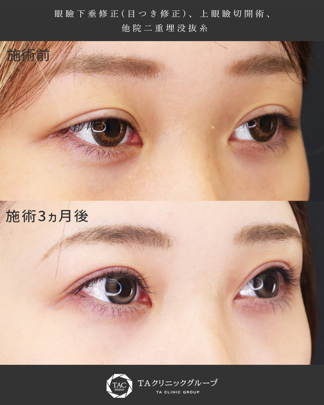 眼瞼下垂（目つき矯正）/上眼瞼切開術/他院修正の症例写真 施術前後 