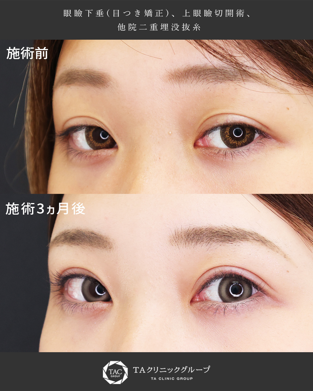 眼瞼下垂（目つき矯正）/上眼瞼切開術/他院修正の症例写真 施術前後 