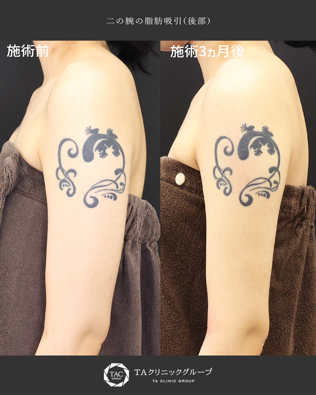 二の腕の脂肪吸引ほっそりとした印象に