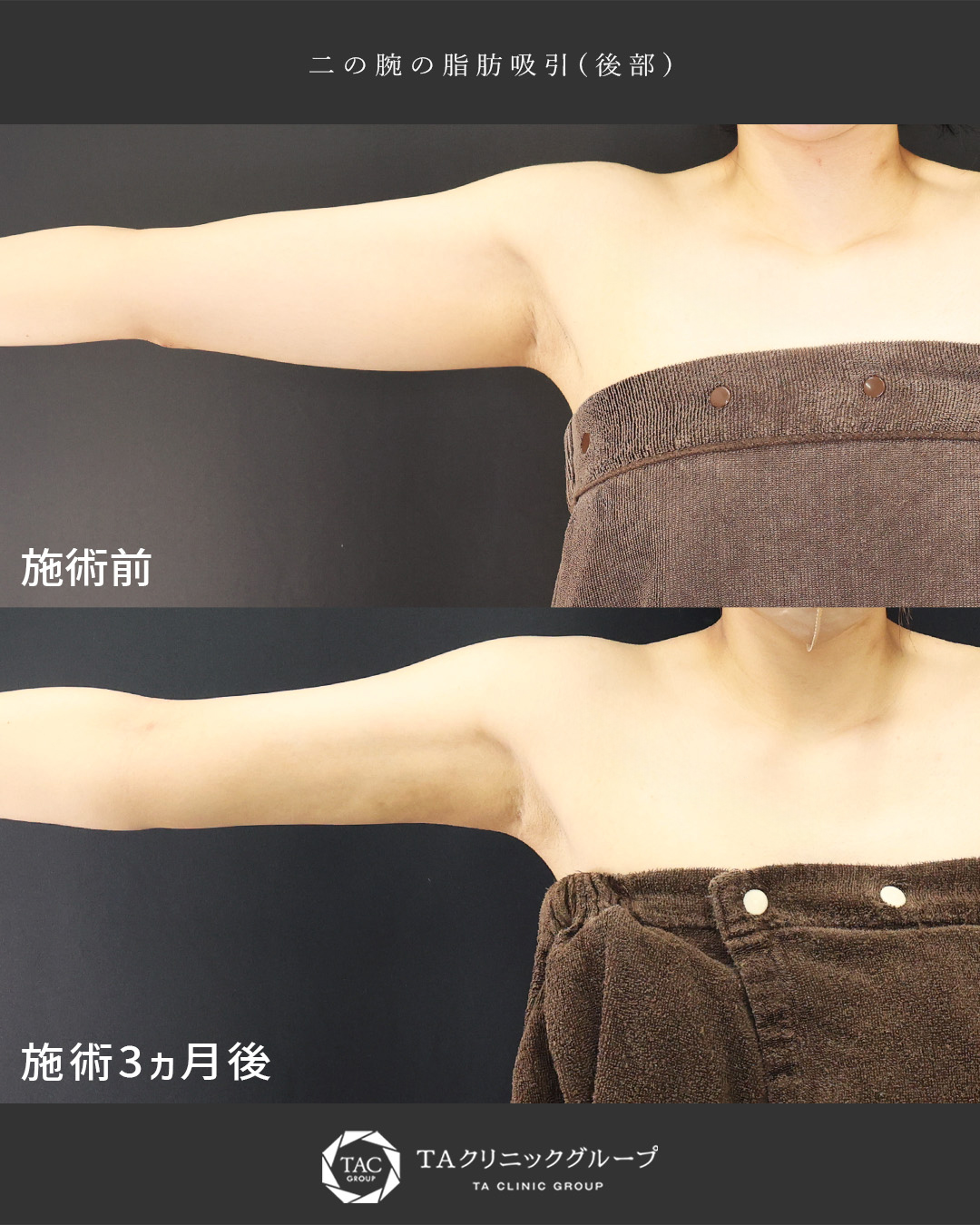 結婚式のドレス映えするほっそり二の腕に【二の腕の脂肪吸引】