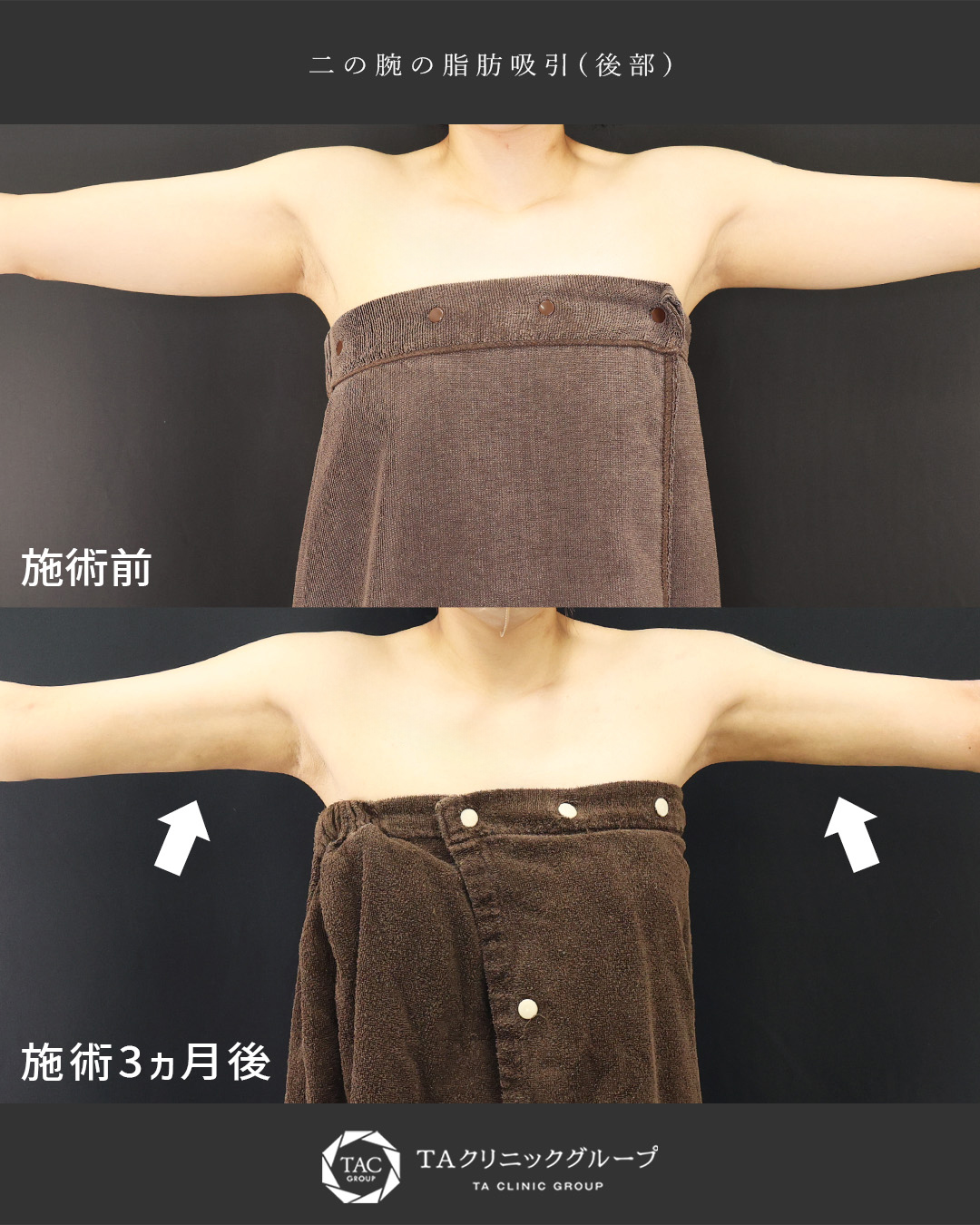 体の脂肪吸引の症例写真 施術前後 