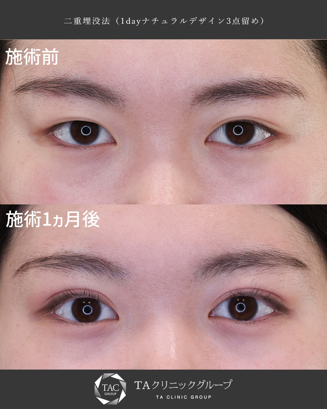 【二重埋没法】まつ毛の生え際が見える美しいMIX二重に