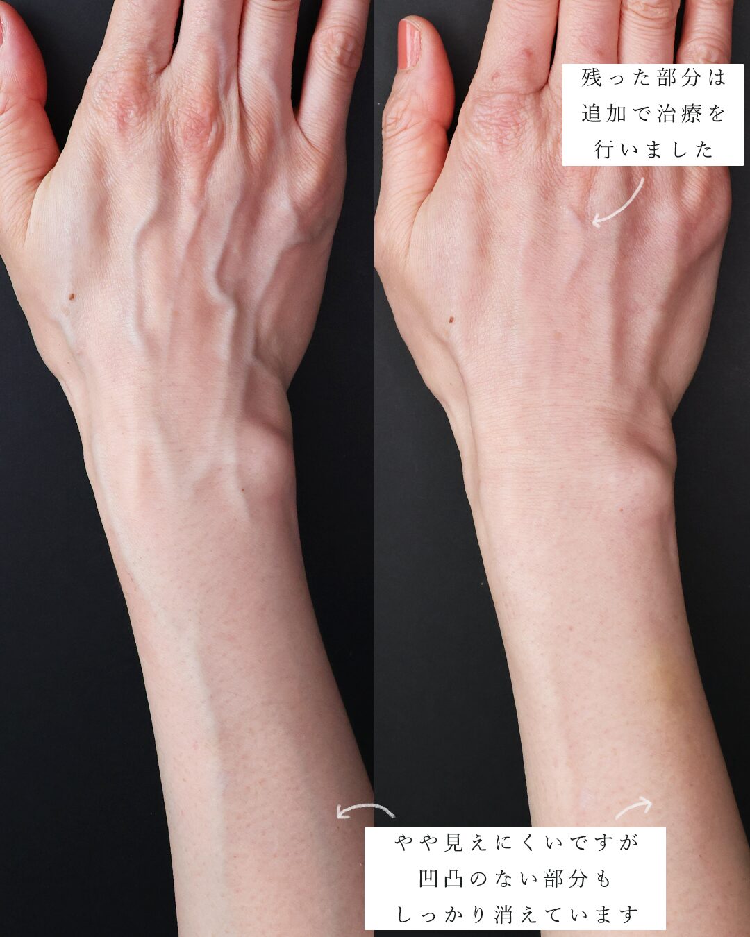 ハンドベイン（手のアンチエイジング・血管治療）の症例写真 施術前後 