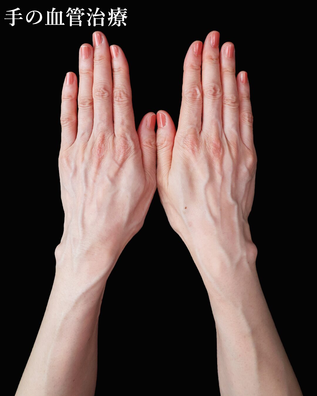 ハンドベイン（手のアンチエイジング・血管治療）の症例写真 施術前後 