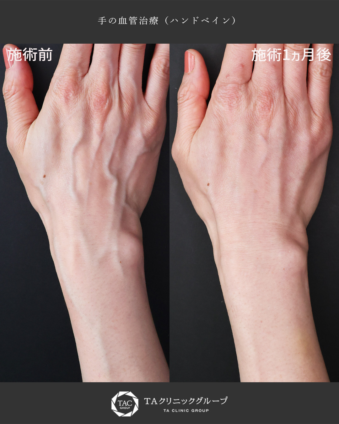 【ハンドベイン治療】手の甲の血管を根本から改善
