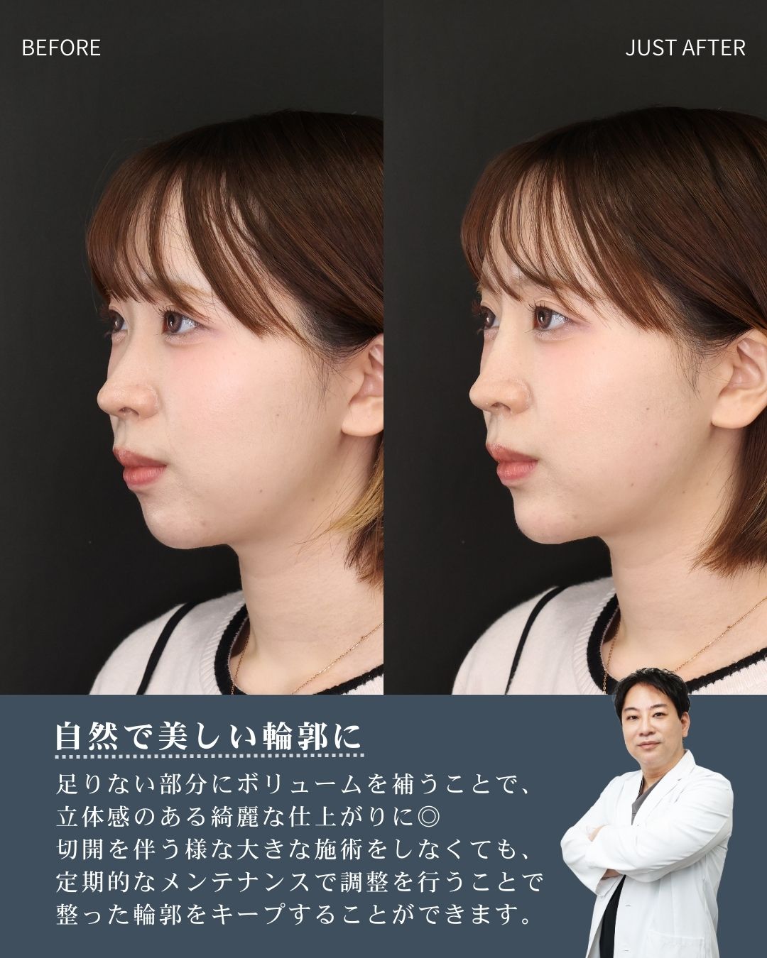 顎のヒアルロン酸注射/鼻のヒアルロン酸注射/エラボトックス注射の症例写真 施術前後 