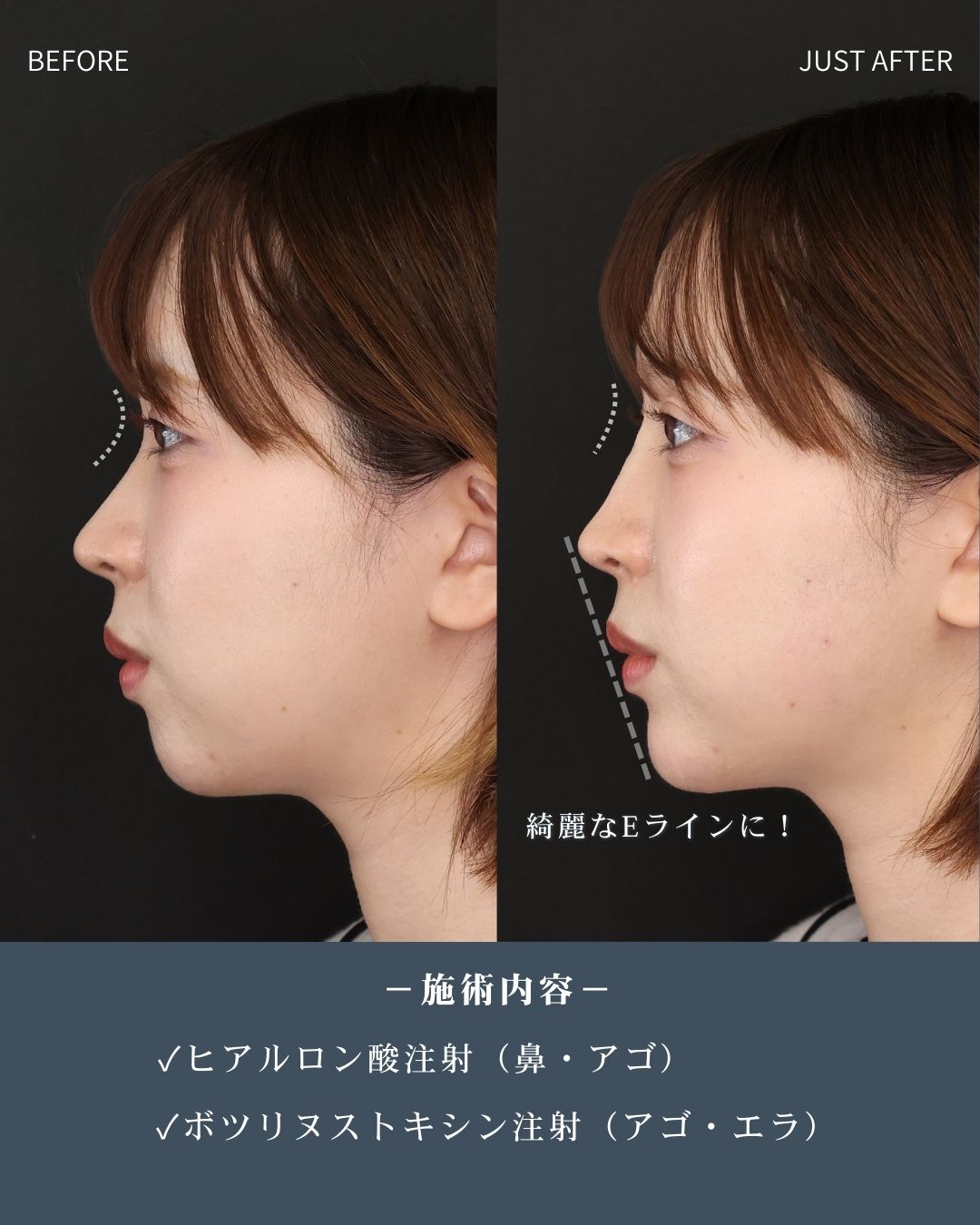 顎のヒアルロン酸注射/鼻のヒアルロン酸注射/エラボトックス注射の症例写真 施術前後 