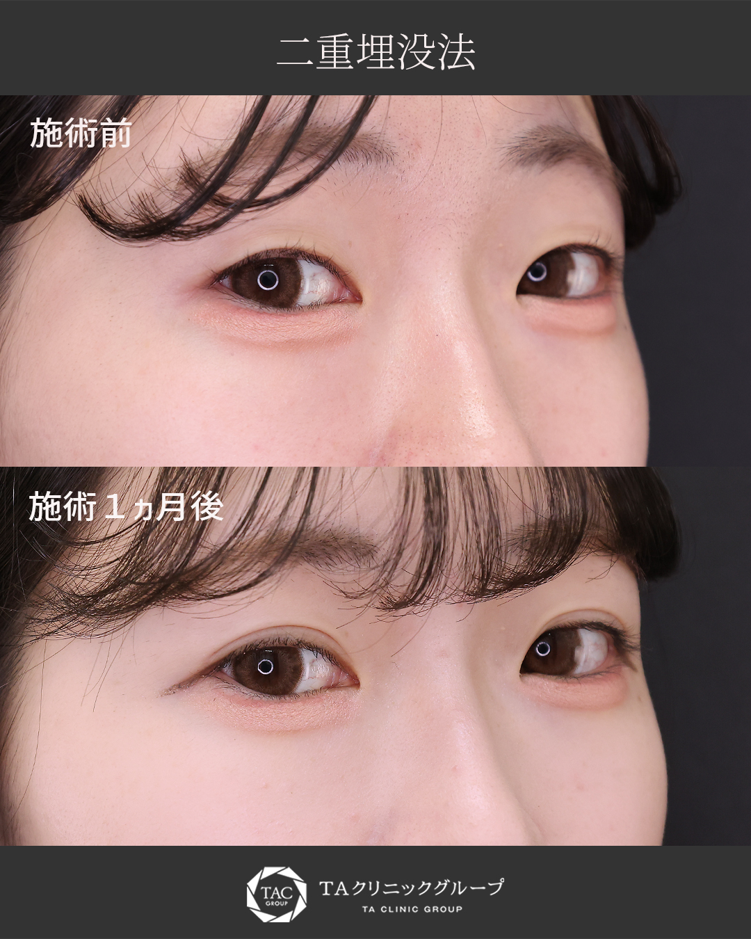 幼さを卒業。自然な末広型二重に