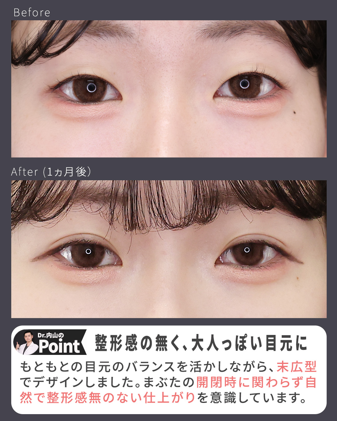 二重埋没法の症例写真 施術前後 