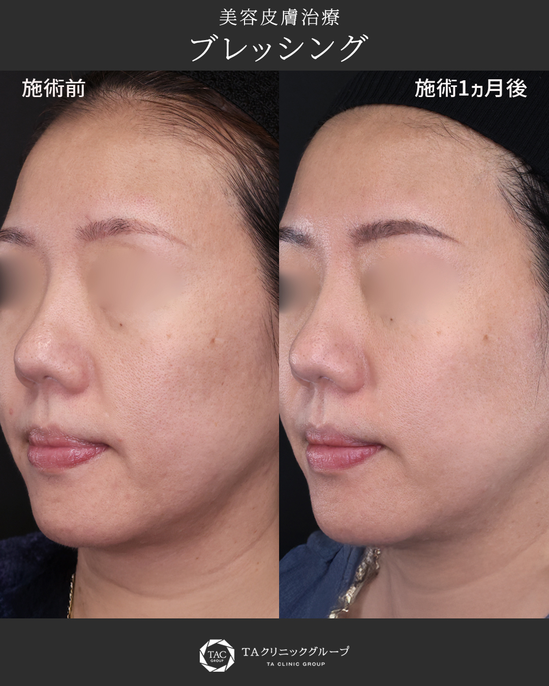 【ブレッシングによる美肌治療】1ヵ月後の改善効果。
