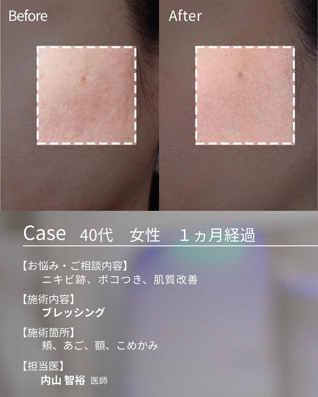 ブレッシングの症例写真 施術前後 