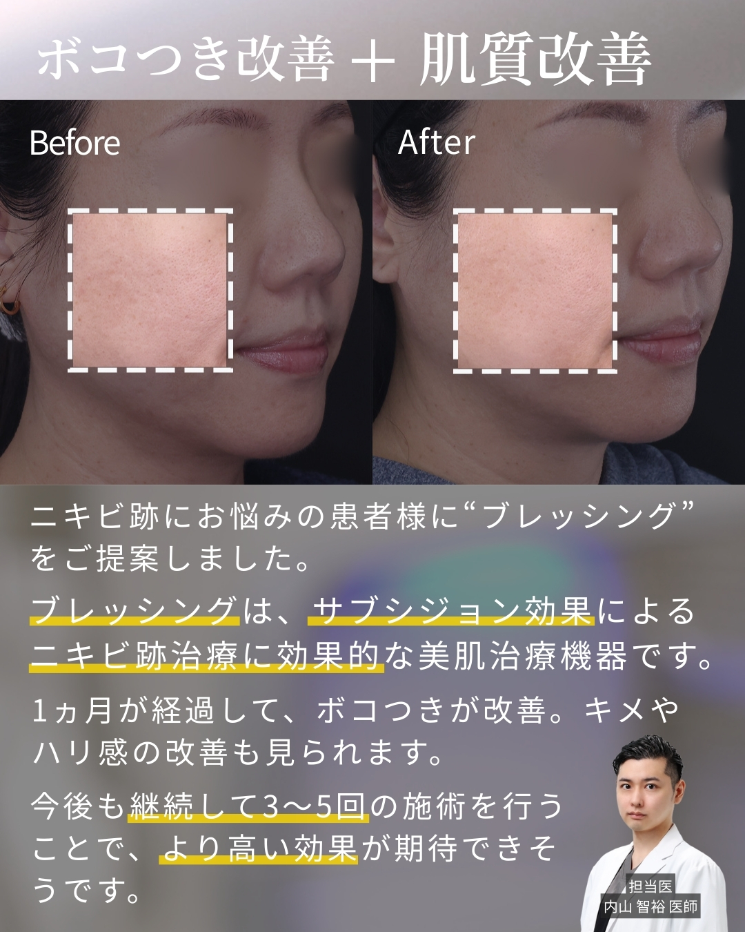 ブレッシングの症例写真 施術前後 