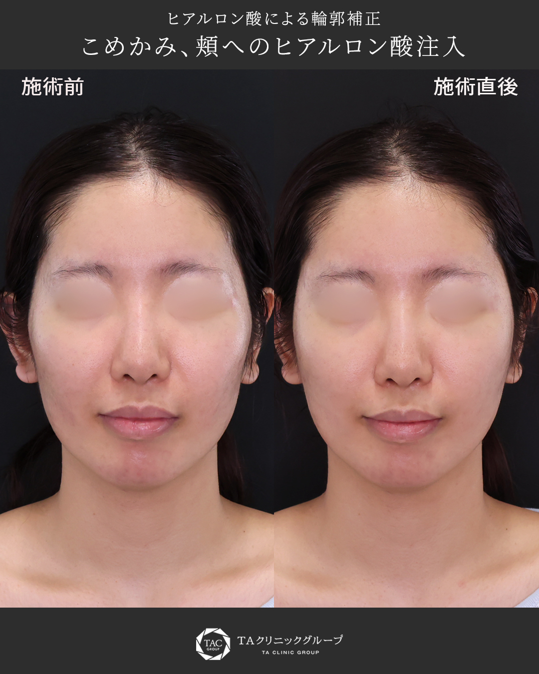 自然にふっくら　ヒアルロン酸で輪郭補正