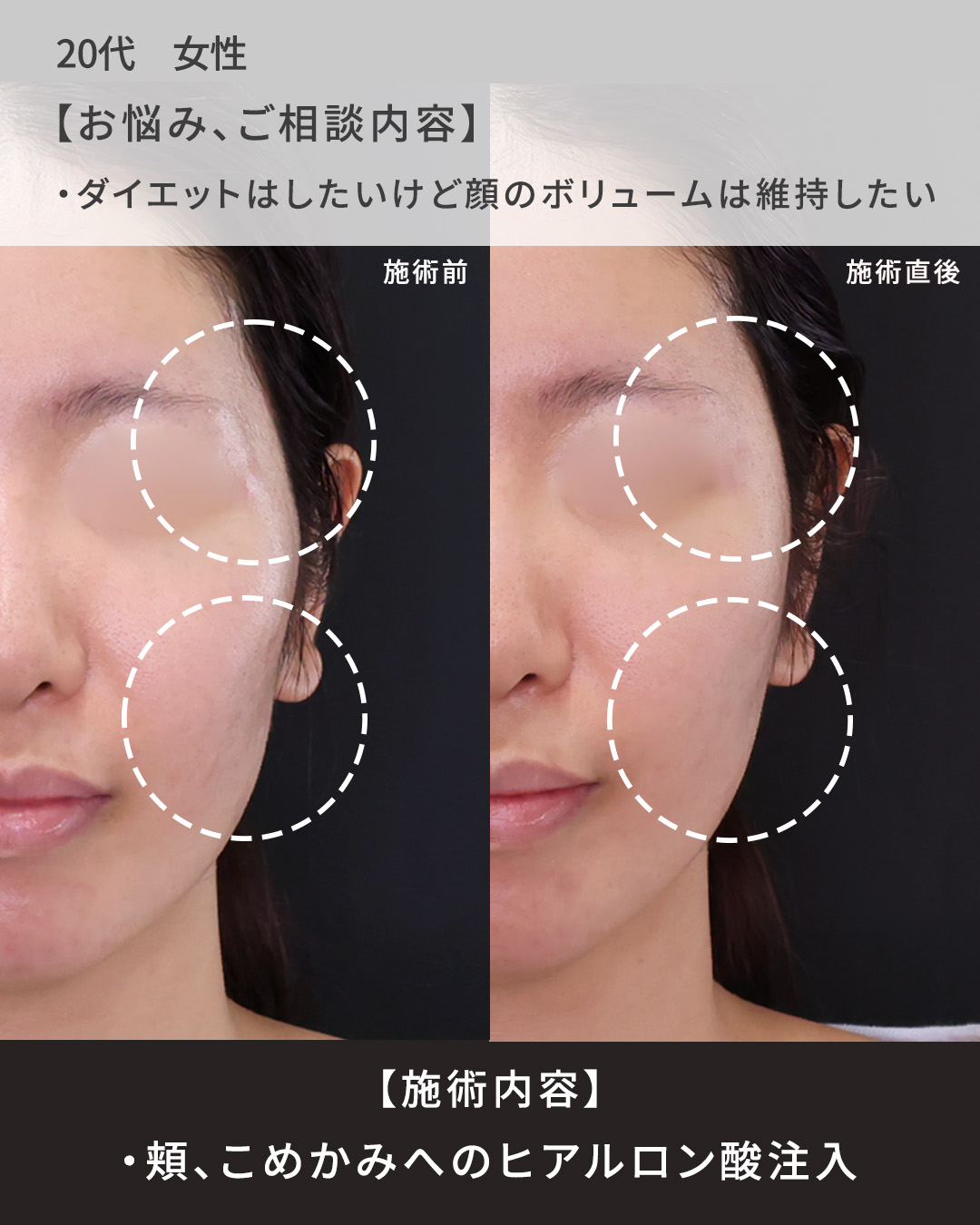 ヒアルロン酸注射：その他/おでこ・こめかみのヒアルロン酸注射の症例写真 施術前後 