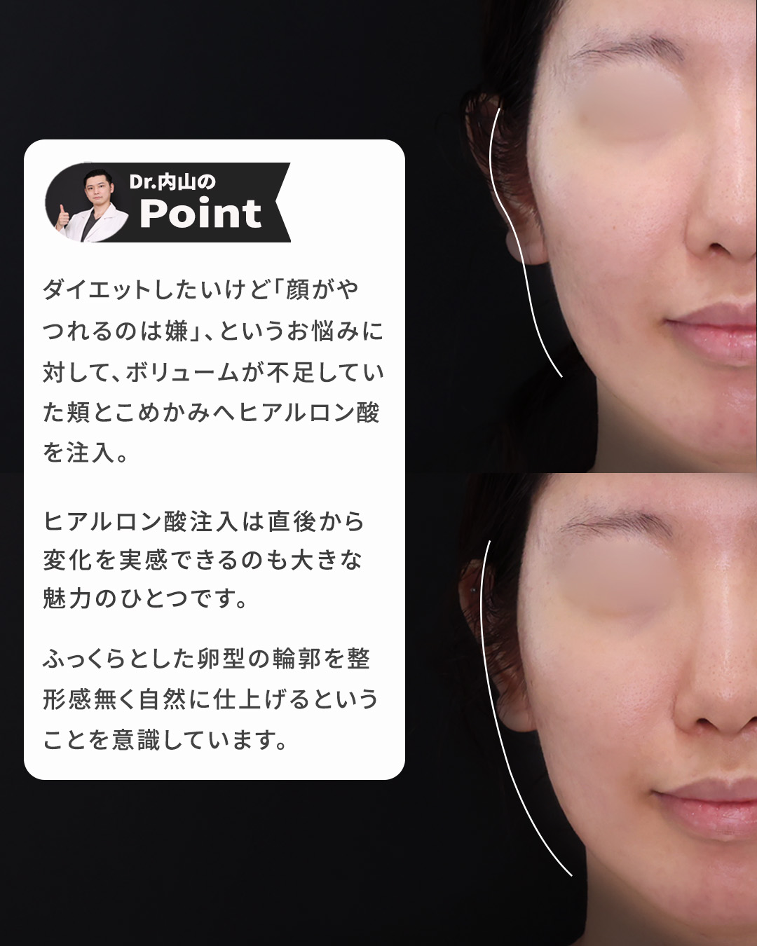 ヒアルロン酸注射：その他/おでこ・こめかみのヒアルロン酸注射の症例写真 施術前後 