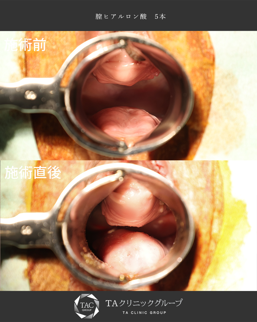 【膣ヒアルロン酸】産後の膣の緩みを改善！