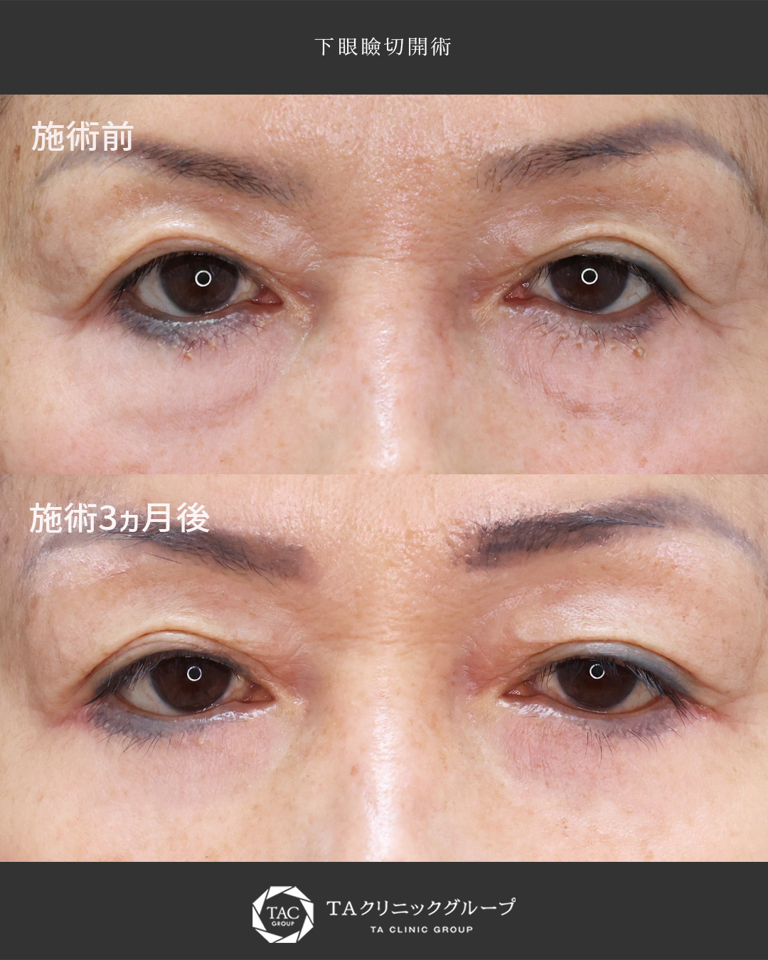 【目の下のたるみ取り】若々しいお目元に