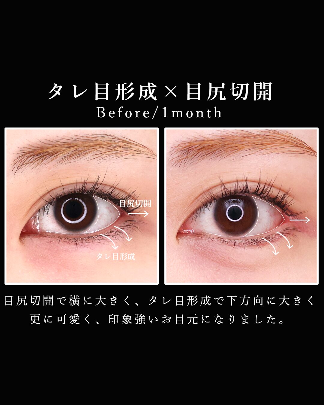 グラマラスライン（タレ目形成）/目尻切開術の症例写真 施術前後 