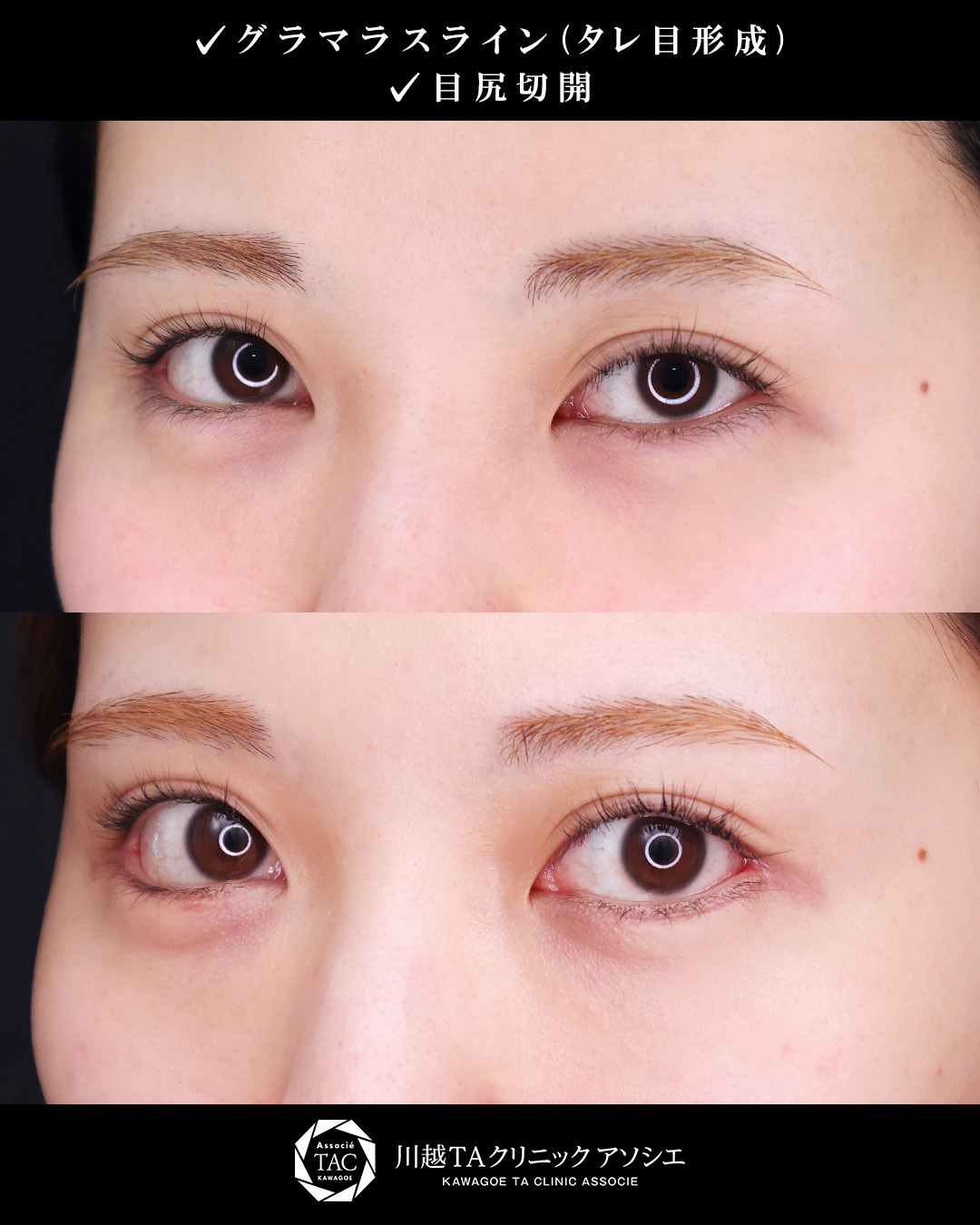 グラマラスライン（タレ目形成）/目尻切開術の症例写真 施術前後 