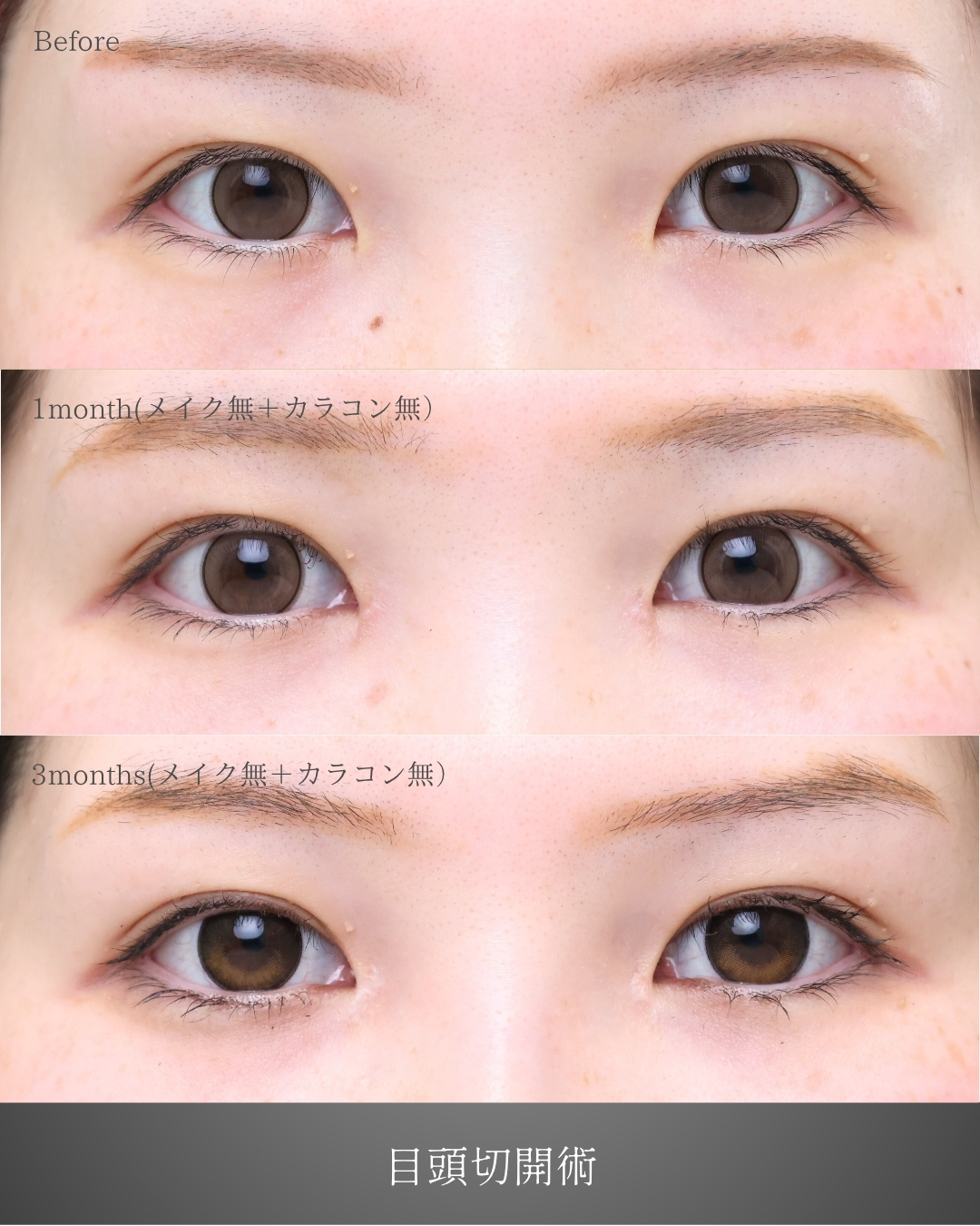 目頭切開術の症例写真 施術前後 