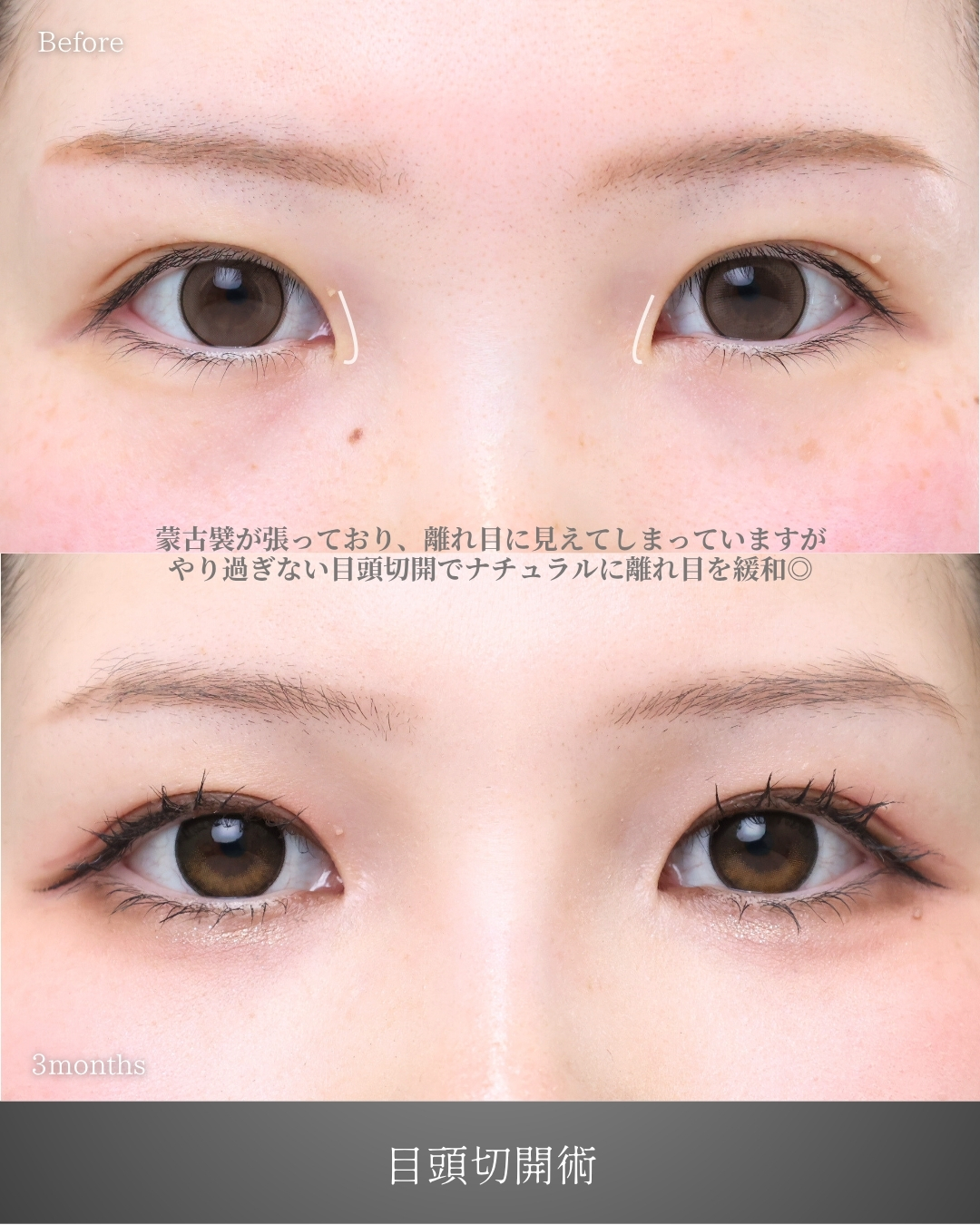 目頭切開術の症例写真 施術前後 
