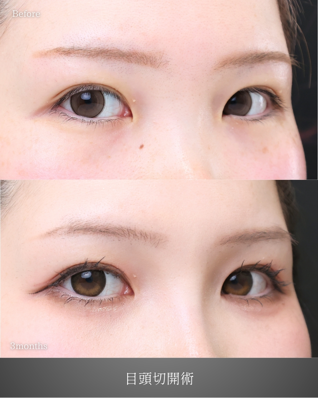 目頭切開術の症例写真 施術前後 