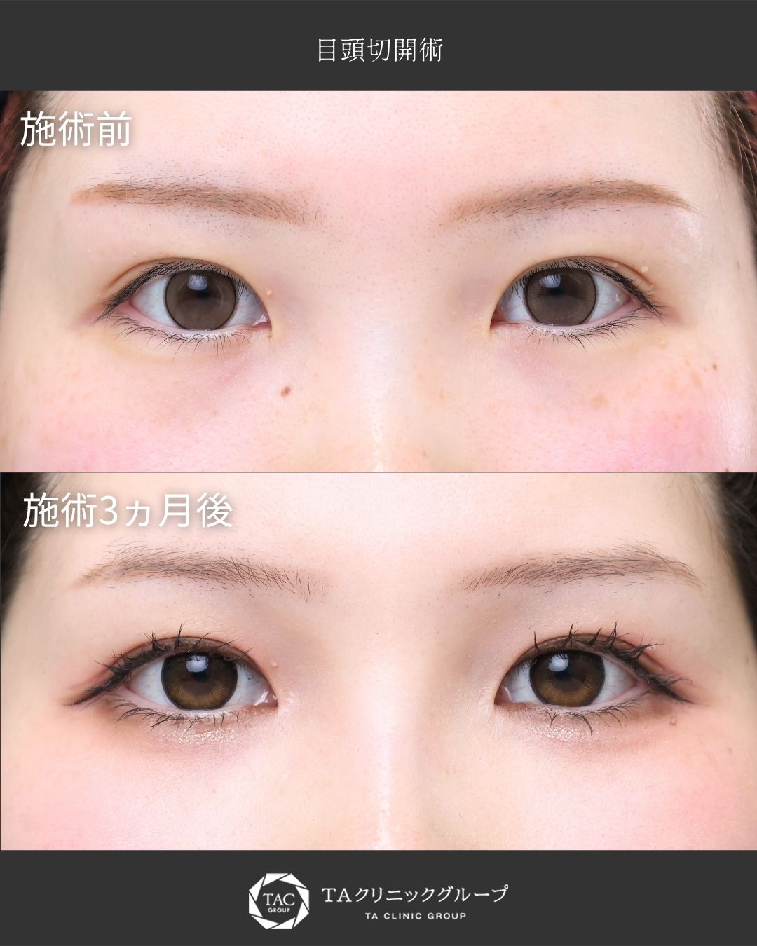 【目頭切開術】｜ナチュラルに離れ目を改善◎