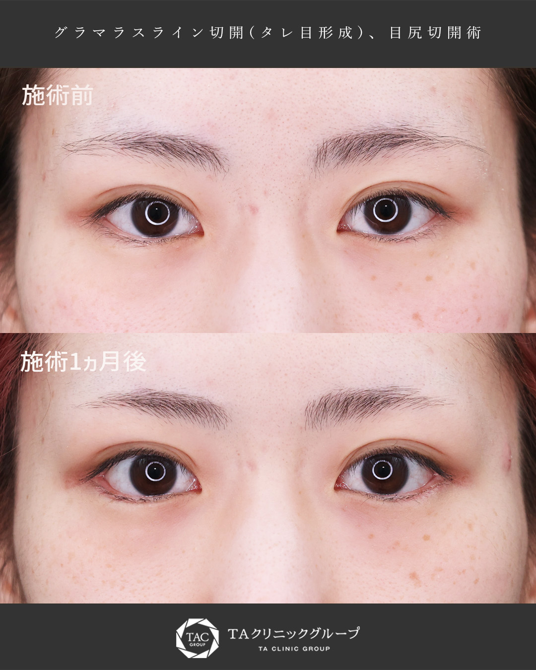 グラマラスライン（タレ目形成）/目尻切開術の症例写真 施術前後 