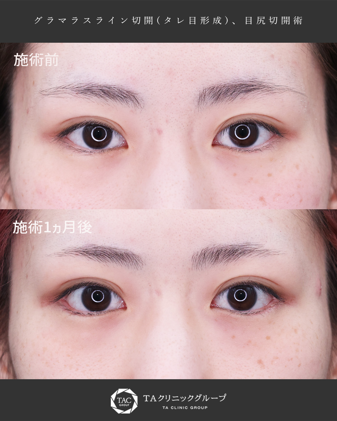 自然な範囲で柔らかく、大きなお目元に【目元複合施術】