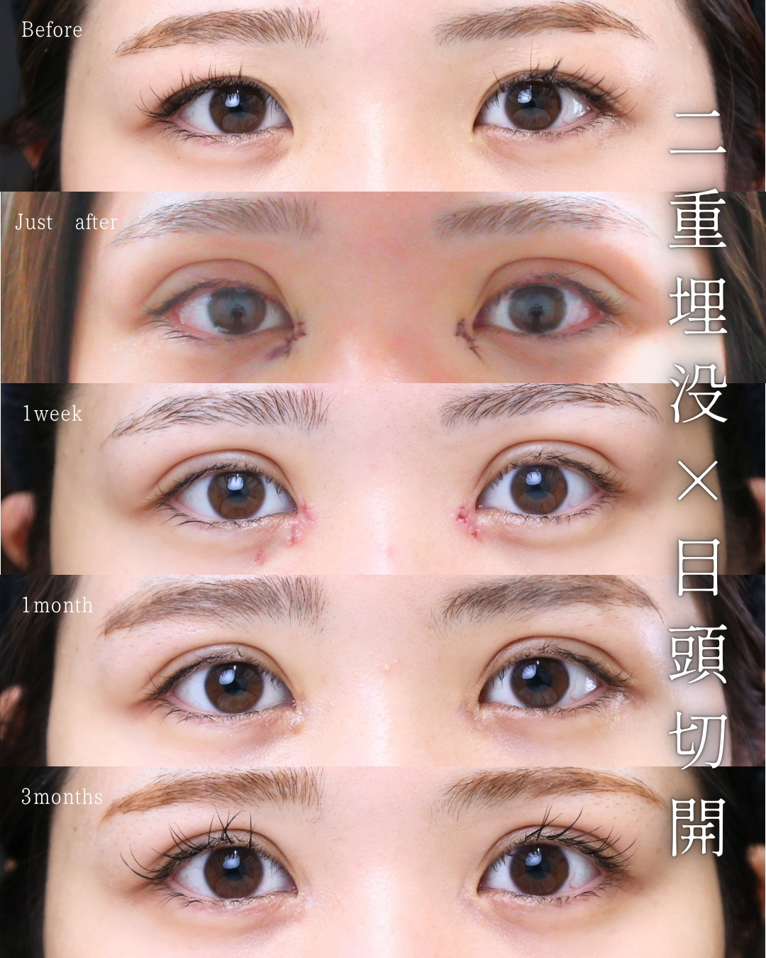 二重埋没法/目頭切開術の症例写真 施術前後 