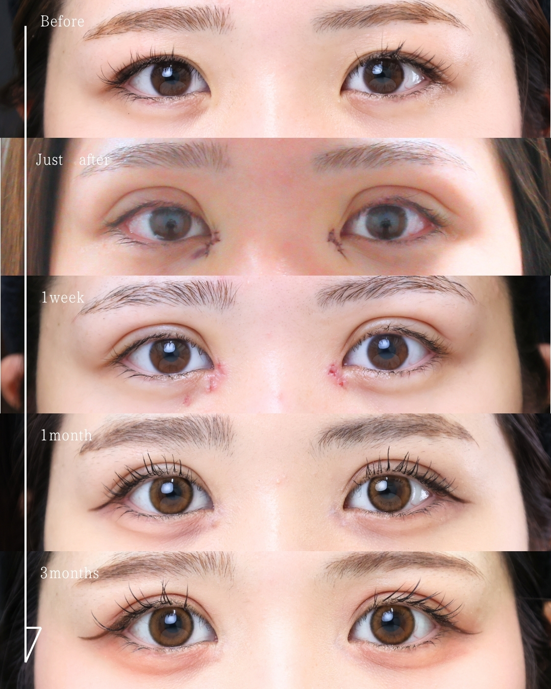 二重埋没法/目頭切開術の症例写真 施術前後 