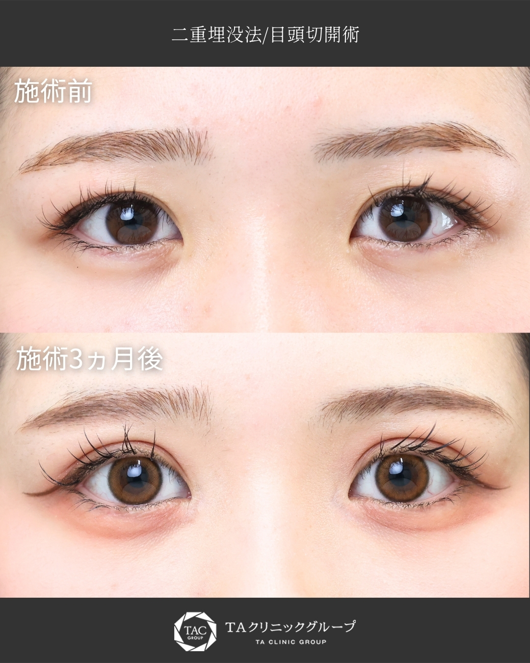 【二重埋没×目頭切開術】｜蒙古襞の張り改善で平行型二重に