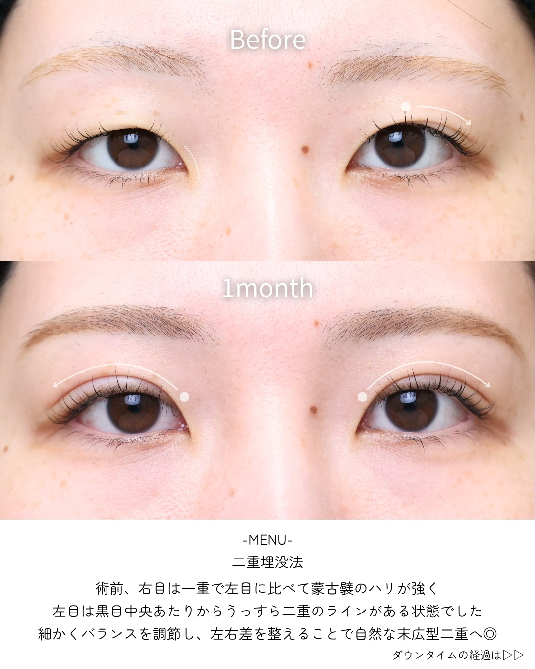 二重埋没法の症例写真 施術前後 