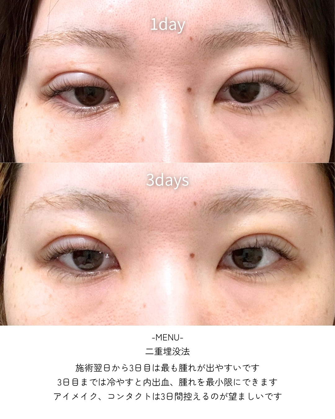 二重埋没法の症例写真 施術前後 