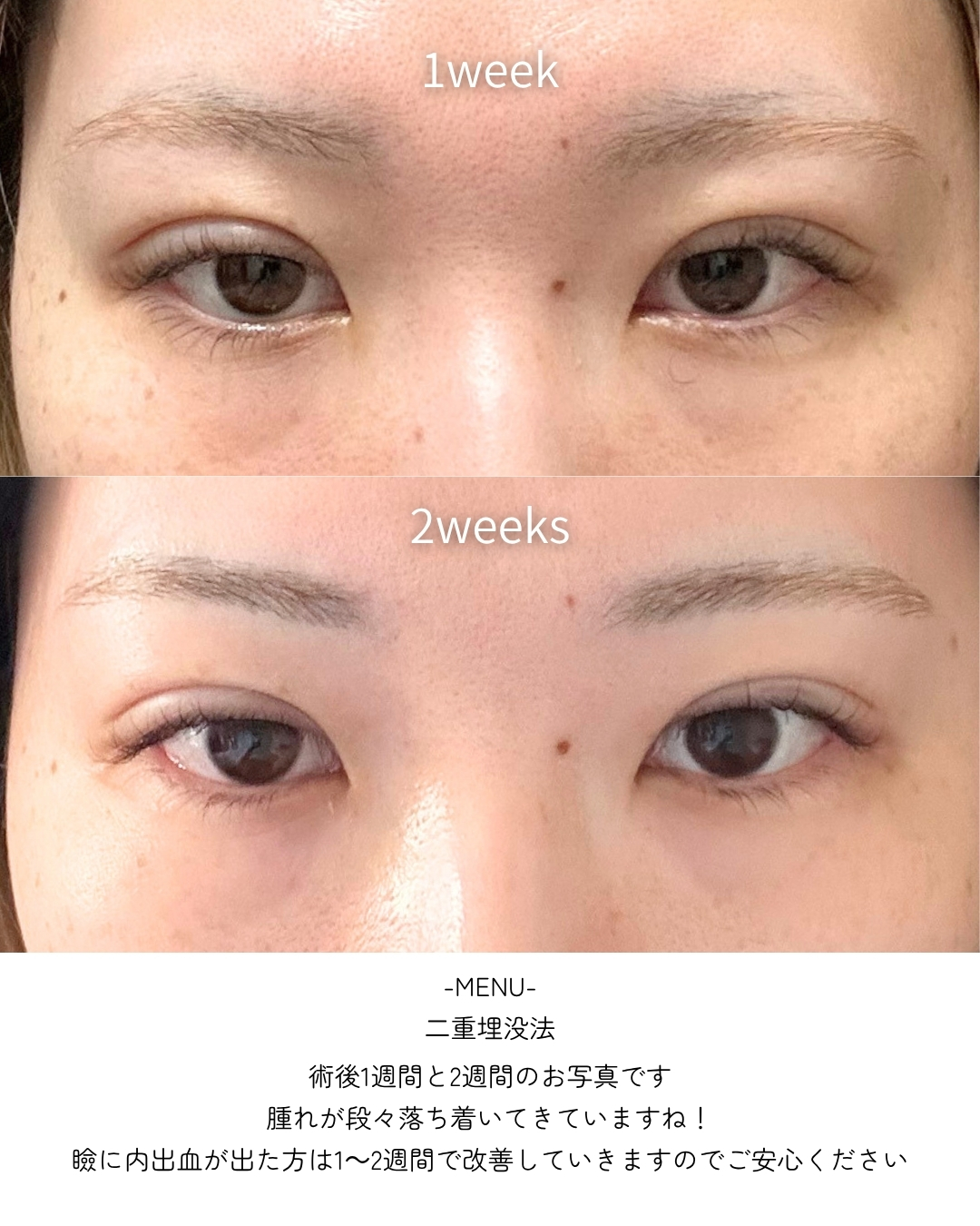 二重埋没法の症例写真 施術前後 