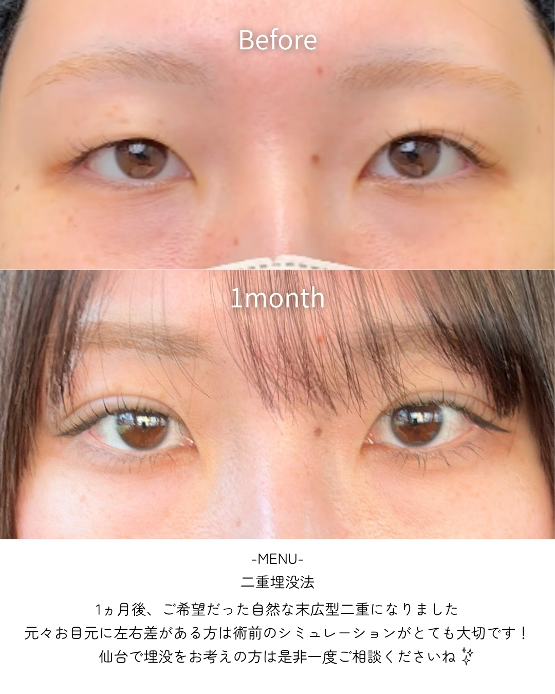 二重埋没法の症例写真 施術前後 