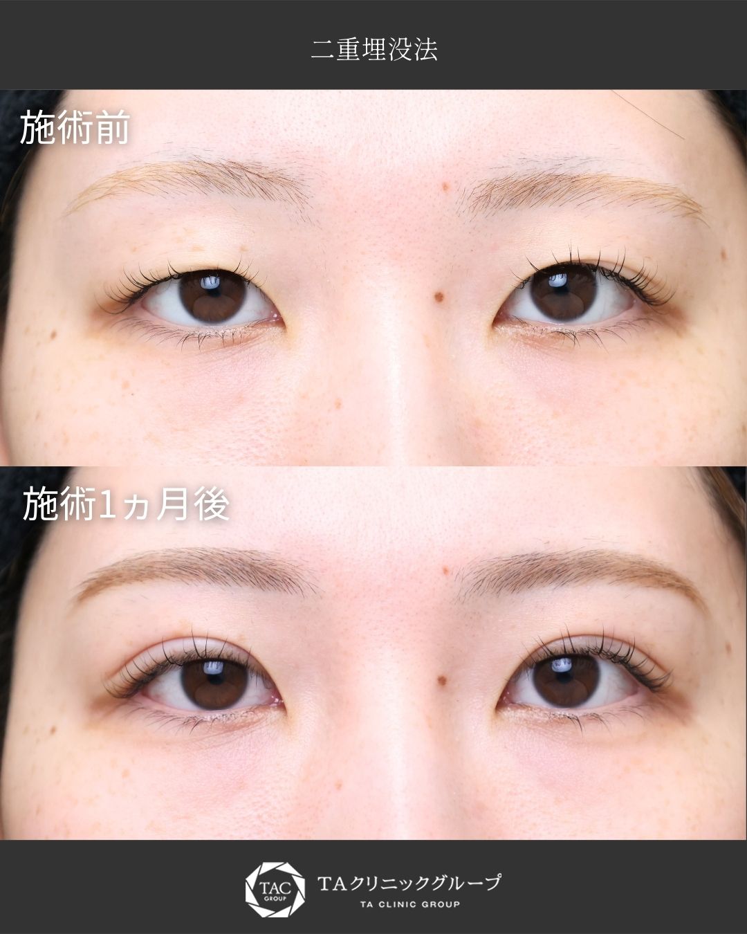 【二重埋没】｜左右差があったお目元から自然な末広型二重に