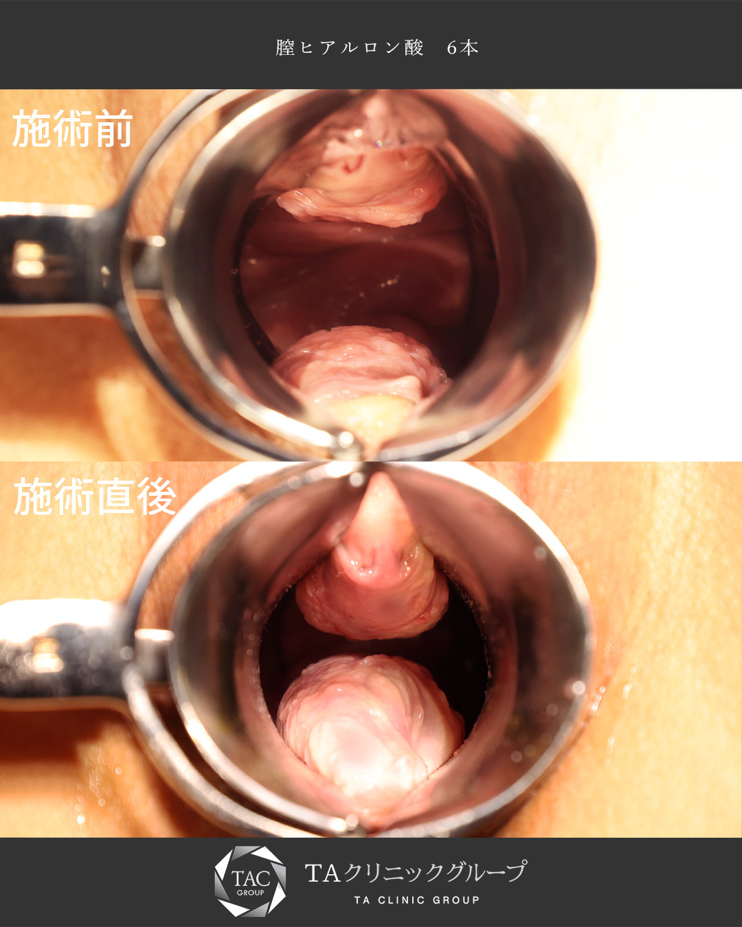 【膣ヒアルロン酸】産後の緩み、お湯漏れ…。ヒアルロン酸で解決！