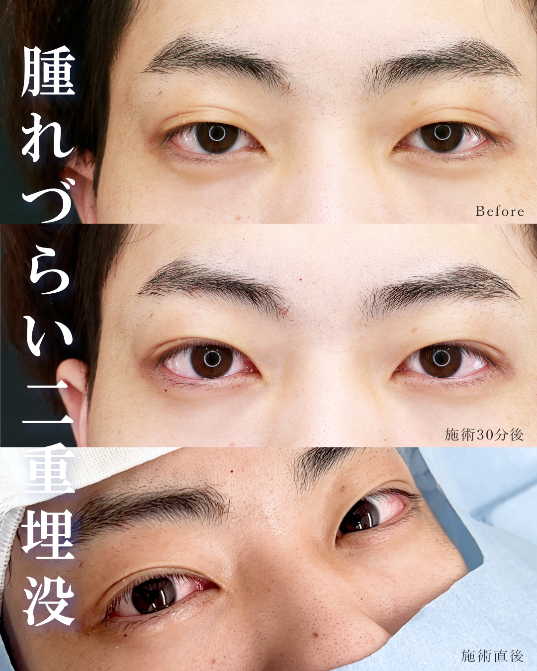 クイックコスメリングの症例写真 施術前後 