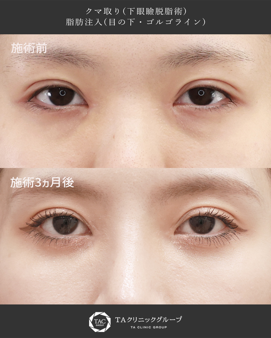 20代女性のクマ取り症例｜下眼瞼脱脂＋脂肪注入で、目元のふくらみと段差を根本改善◎