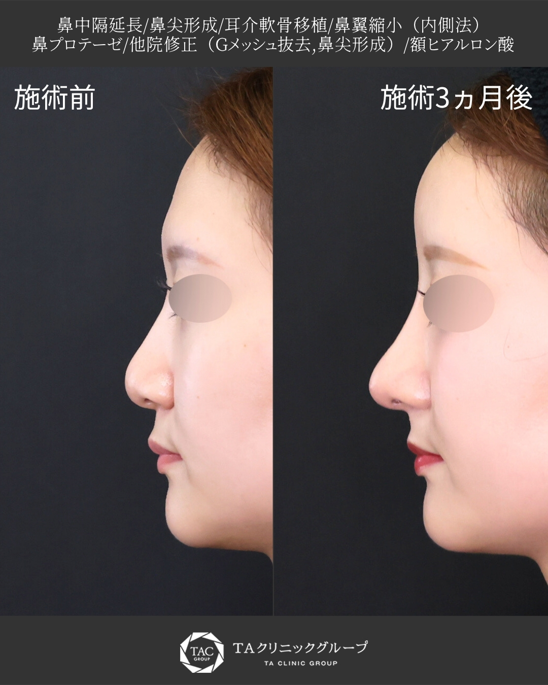 【鼻フル整形】｜他院修正＋S字カーブを整える