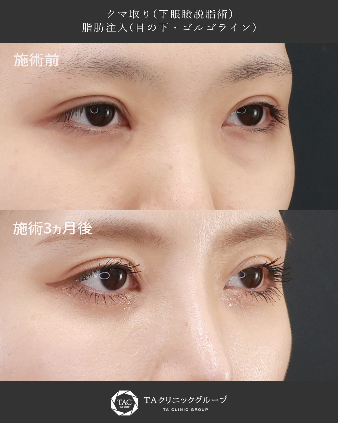 下眼瞼脱脂術（目の下のたるみ取り・目の下の脂肪ふくらみ取り）の症例写真 施術前後 