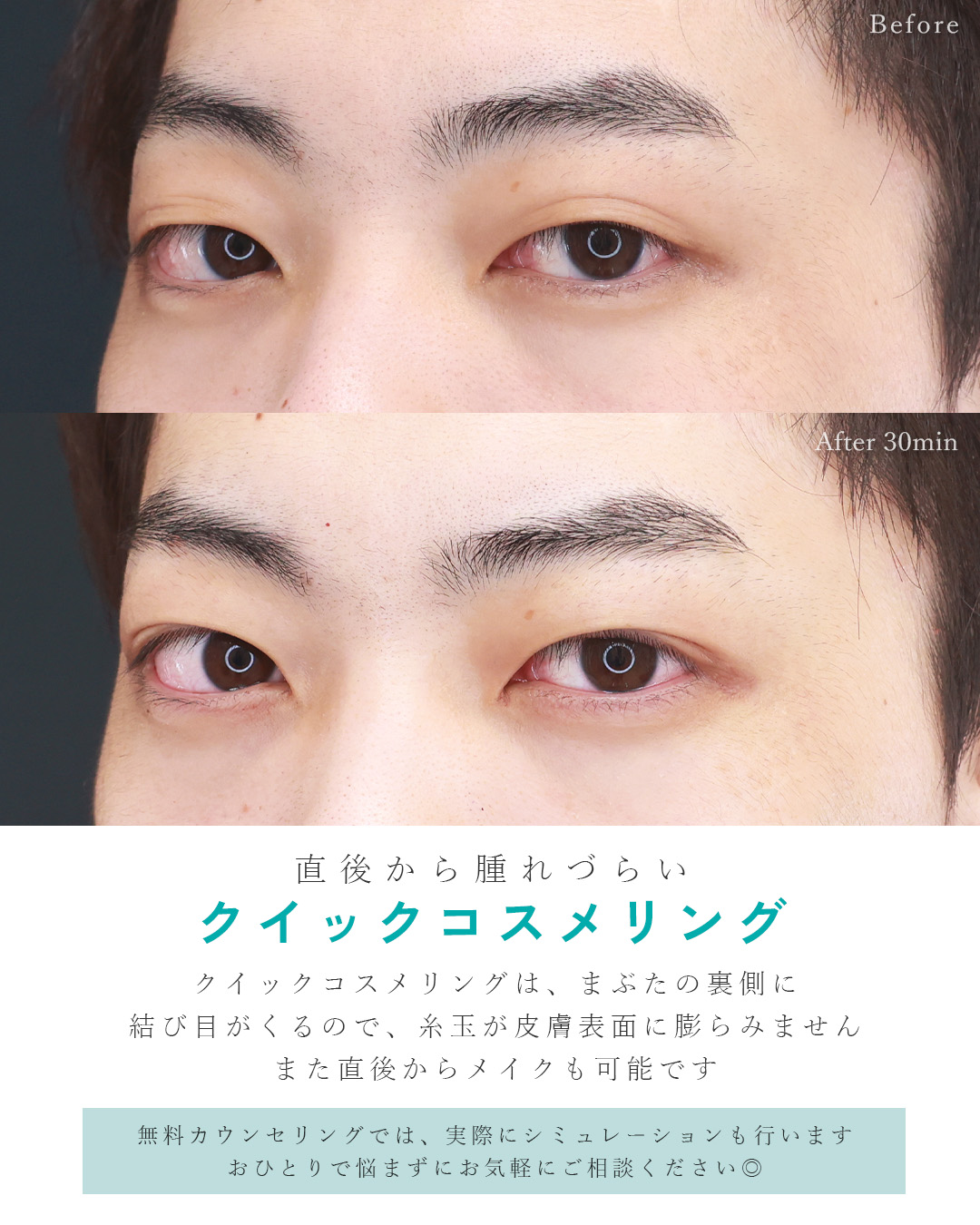 クイックコスメリングの症例写真 施術前後 
