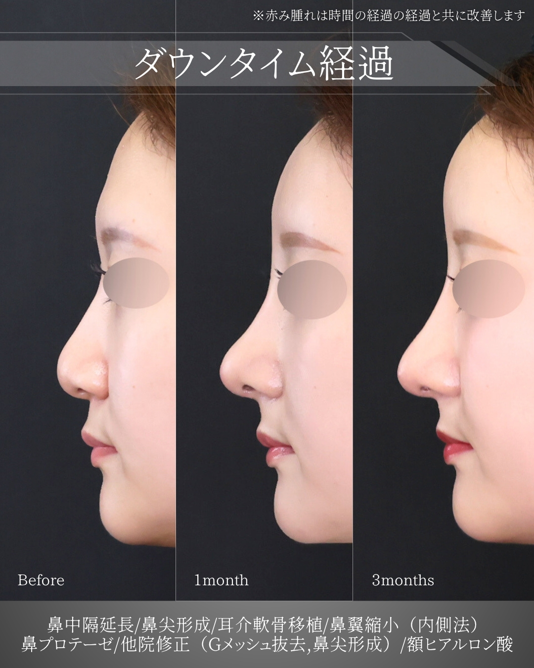 鼻中隔延長術/鼻先軟骨移植/鼻尖形成・鼻尖縮小の症例写真 施術前後 